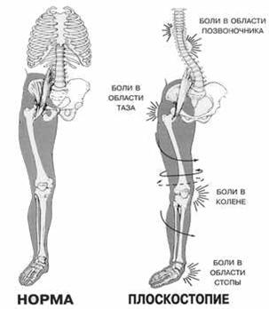 Общие скелетно-мышечные деформации, которые вызывает плоскостопие