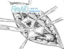 Варианты обработки грыжевого мешка.